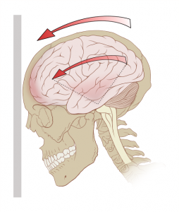 538px-Concussion_mechanics.svg